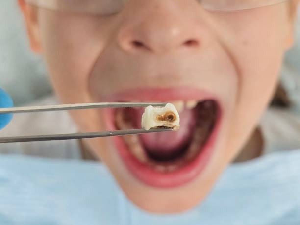 Best Emergency Dentist for Lost Fillings or Crowns in Trenton, TN